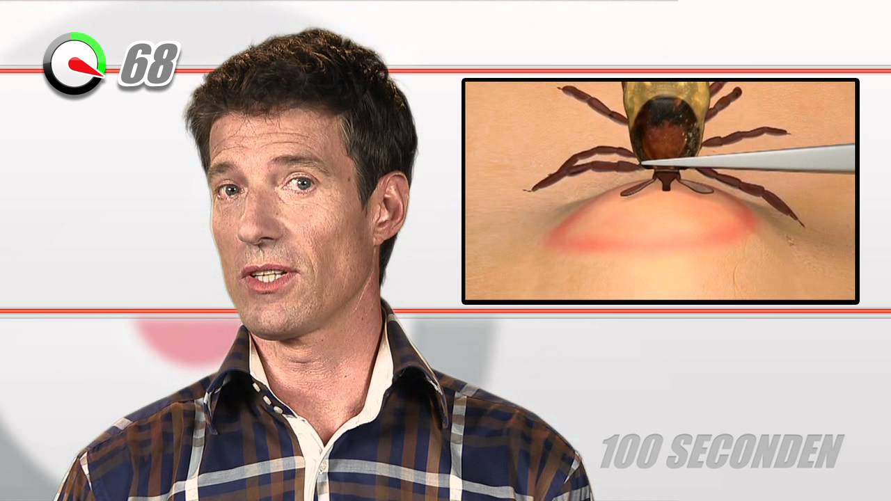 Tekenbeet | 100 Seconden Dokter
