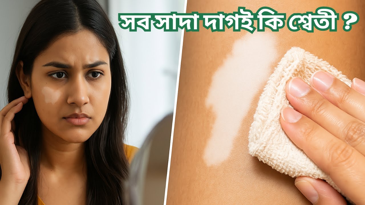 সাদা দাগ শ্বেতী কিনা বুঝবেন কীভাবে? ঘরোয়া ৩টি পরীক্ষায় জেনে নিন।White spot #facts