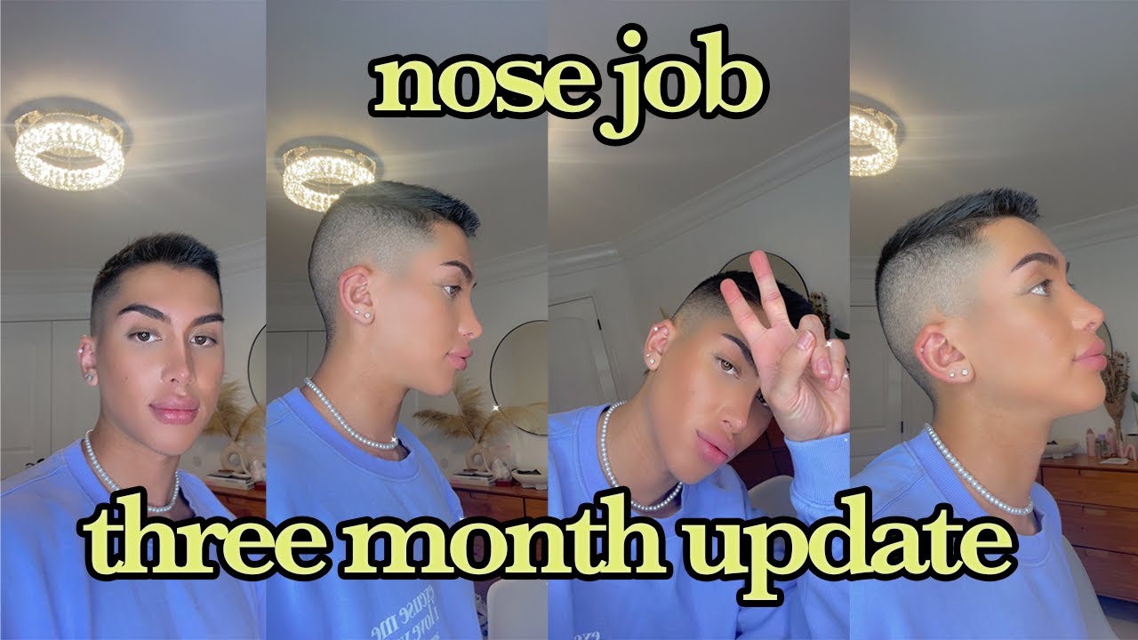 three month nose job update (doctor, price, etc.)
