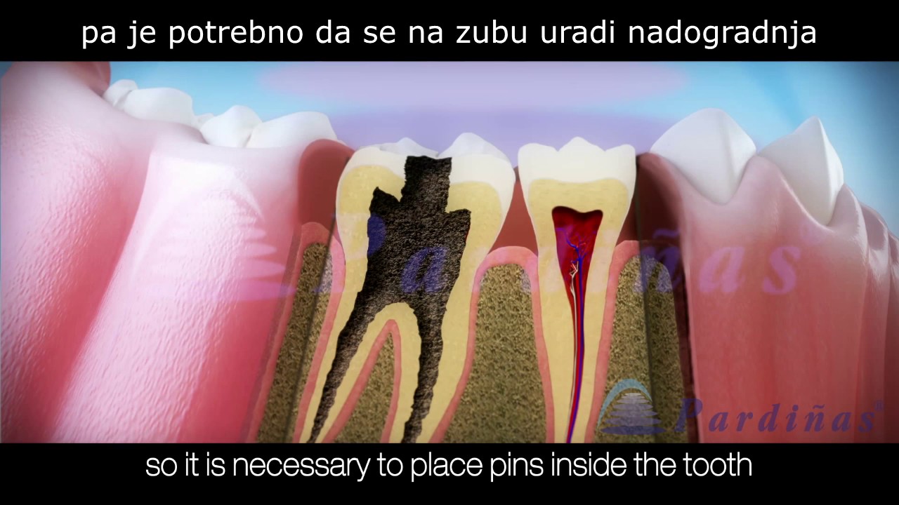 endodoncija - postupak lecenja zuba