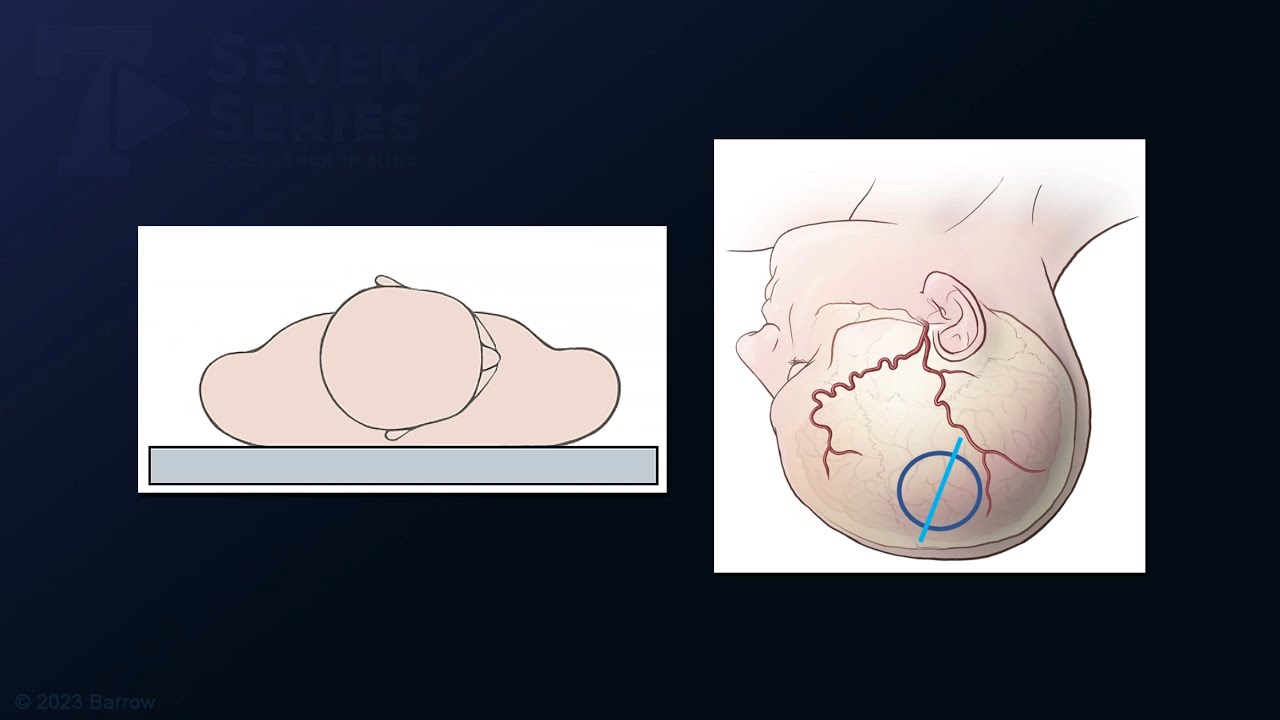 Transsulcal Resection of a Giant Cavernous Malformation in the Left Rolandic Region