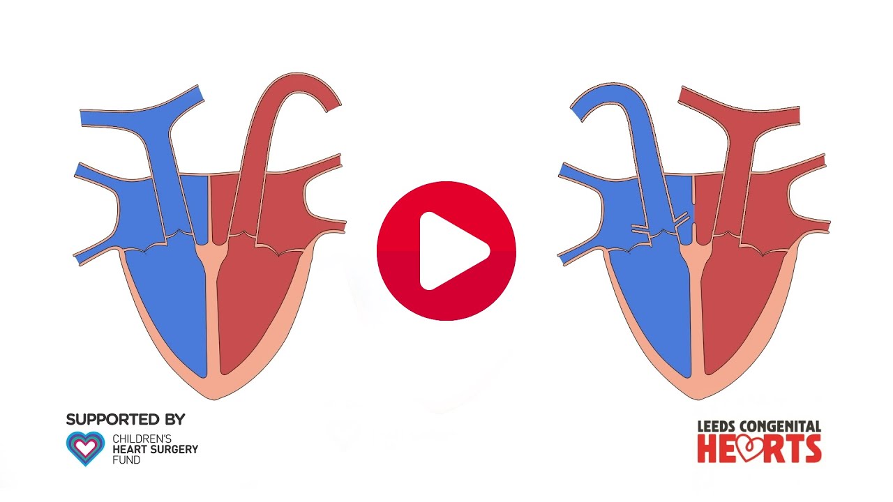 Transposition of the Great Arteries