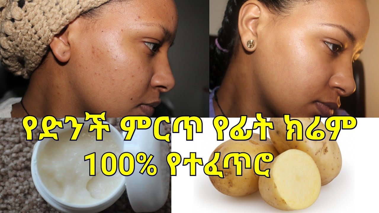 የጠቋቆሩና የሞተ ቆዳን በፍጥነት የሚያነሳ ልዩ የተፍጥሮ የድንች ክሬም