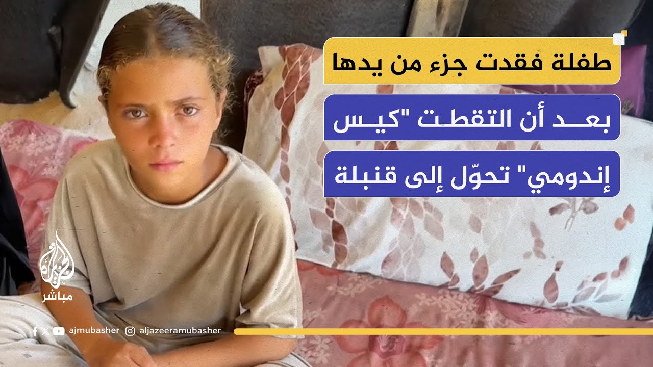 مأساة الطفلة جميلة.. فقدت جزء من يدها بسبب 