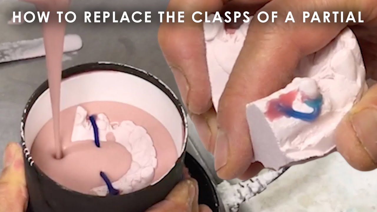 How to replace the Clasps of a Partial