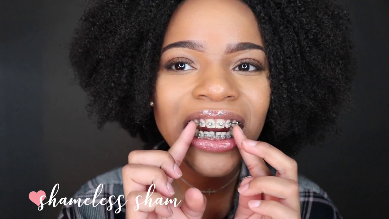 4 MONTH BRACES UPDATE | POWER CHAINS & MORE