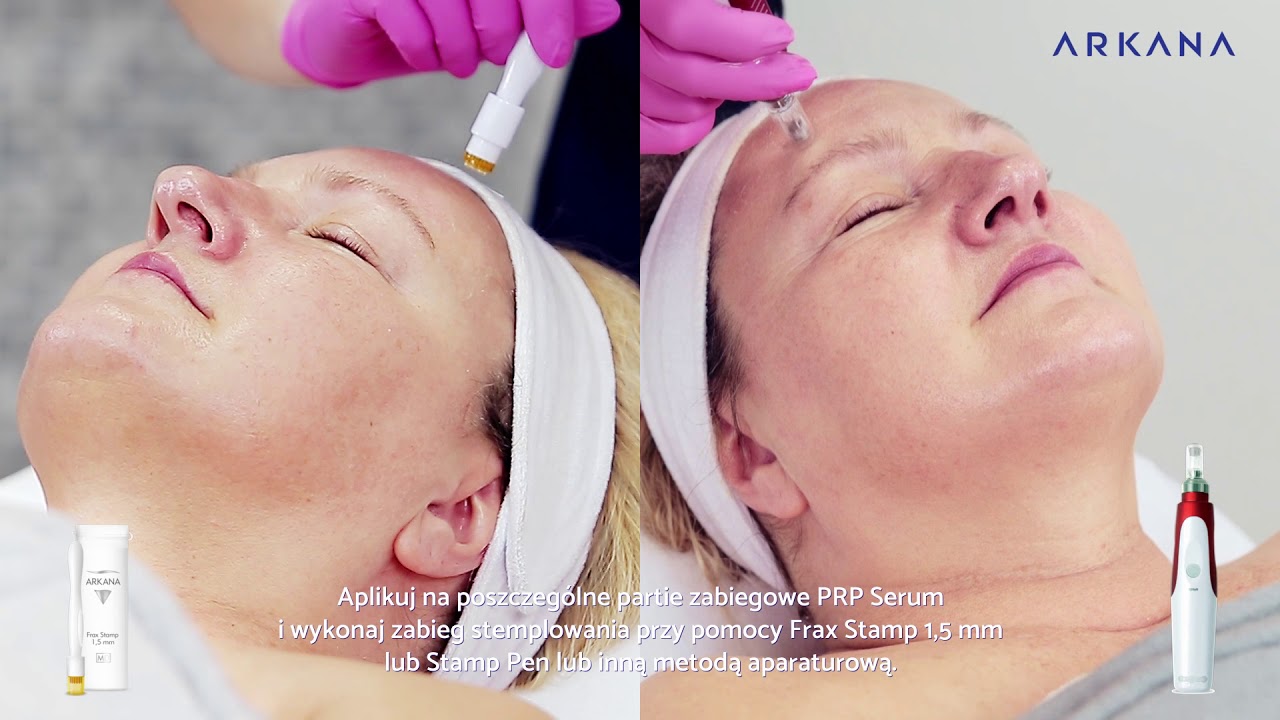 PRP-like Therapy - Zabieg frakcyjnego stemplowania z efektem PRP