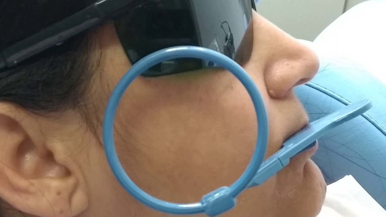 Tratamento endod&ocirc;ntico ( canal) , utilizando o posicionador cone endo ,dando a medida exata do dente