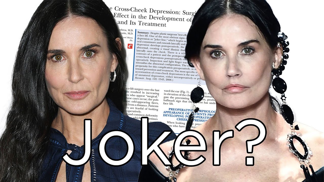 What happened to Demi Moore's face? Not buccal fat pad removal according to Dr. Zelken. A Lip Lift?