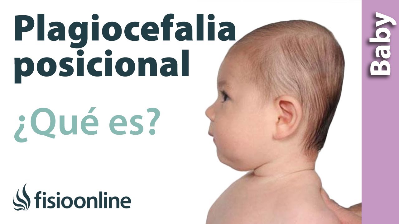 Plagiocefalia posicional o deformacional - ¿Qué es?