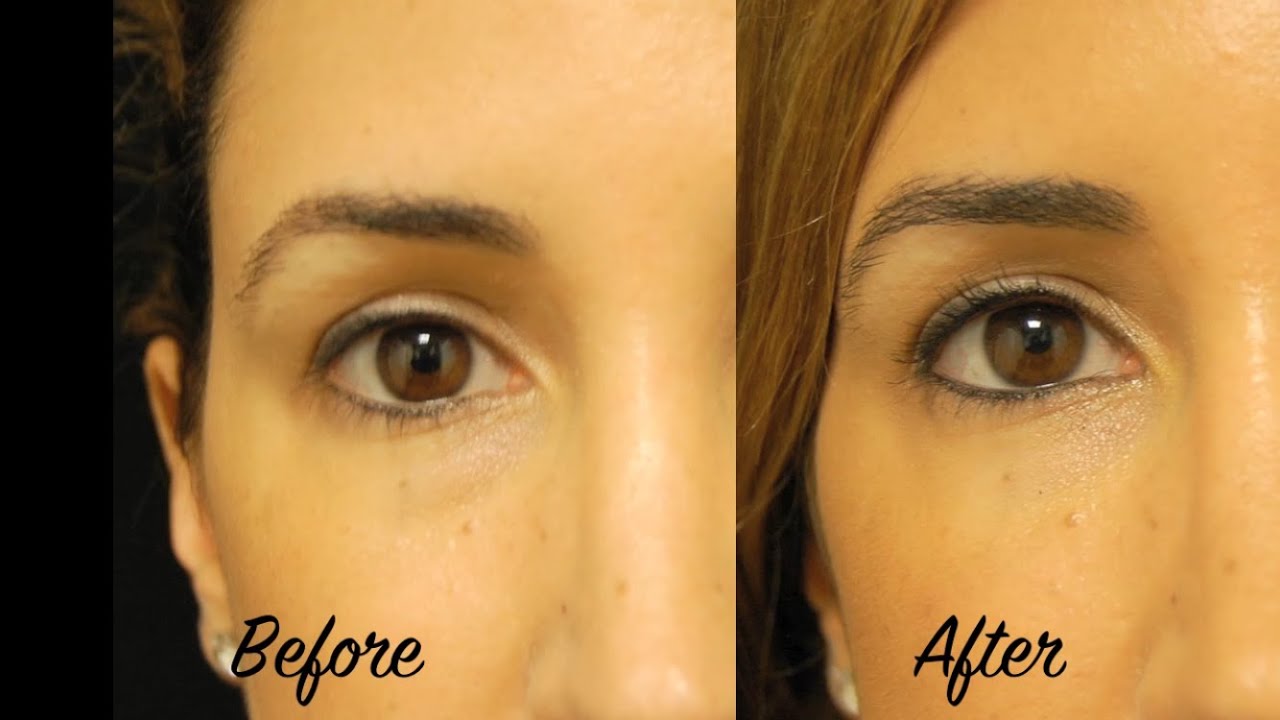 No More Tired Eyes - Under Eye Filler and Botox with Tanya Patron, PA-C - Miami Plastic Surgery
