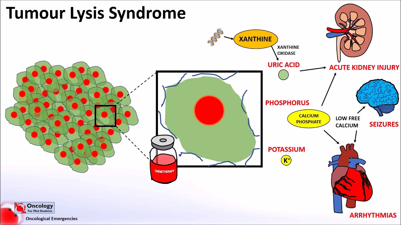 Tumour Lysis Syndrome