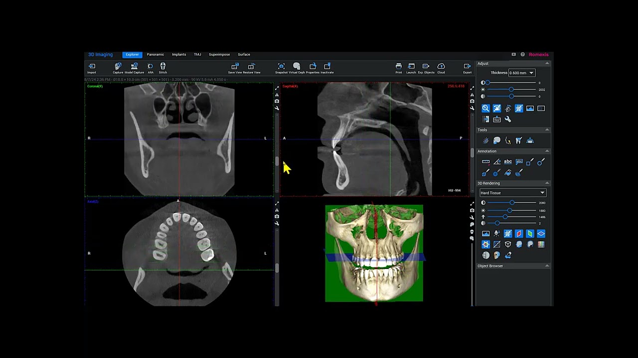 Romexis 6.1 CBCT OverView