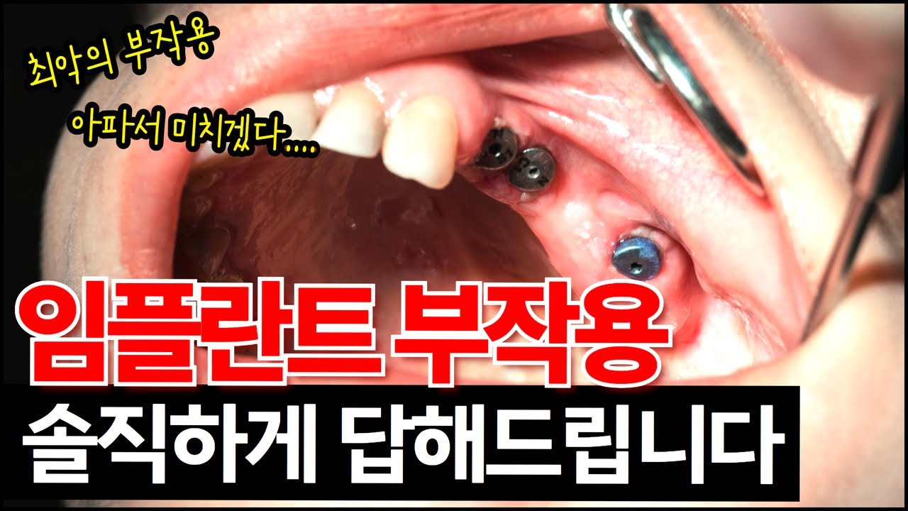 '이거'모르면 평생 후회합니다ㅣ임플란트 부작용 TOP3ㅣ최악의 임플란트 부작용