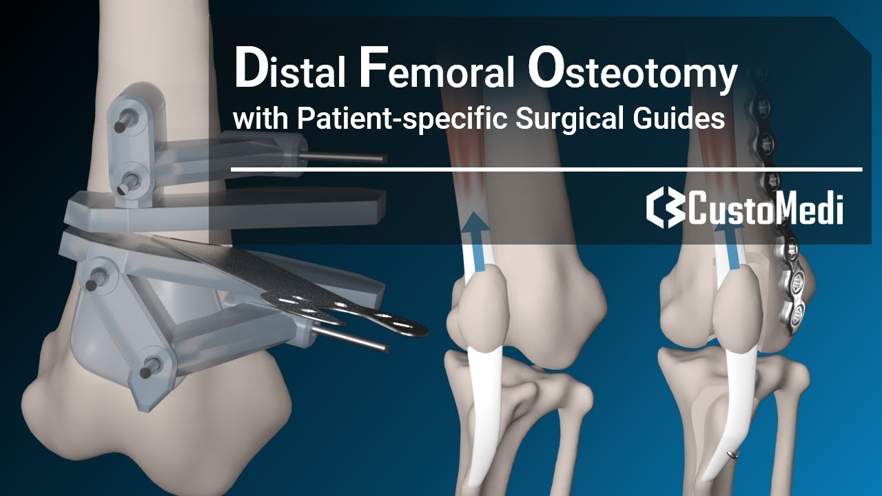 Distal Femoral Osteotomy(DFO) with patient-specific surgical guides