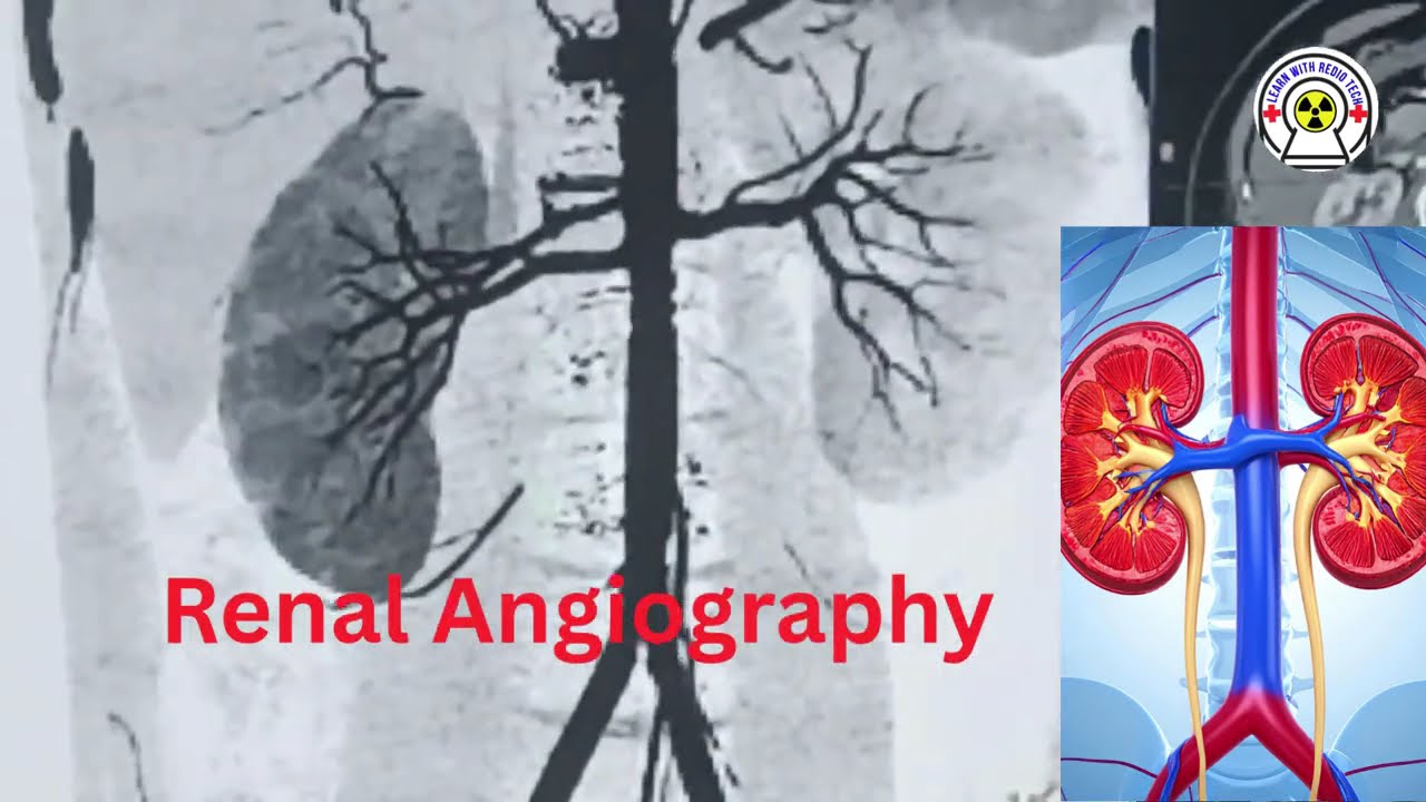 RTENAL ANGIOGRAPHY #RenalAngiography #Radiology #MedicalLearning #KidneyScan #Radiology of student