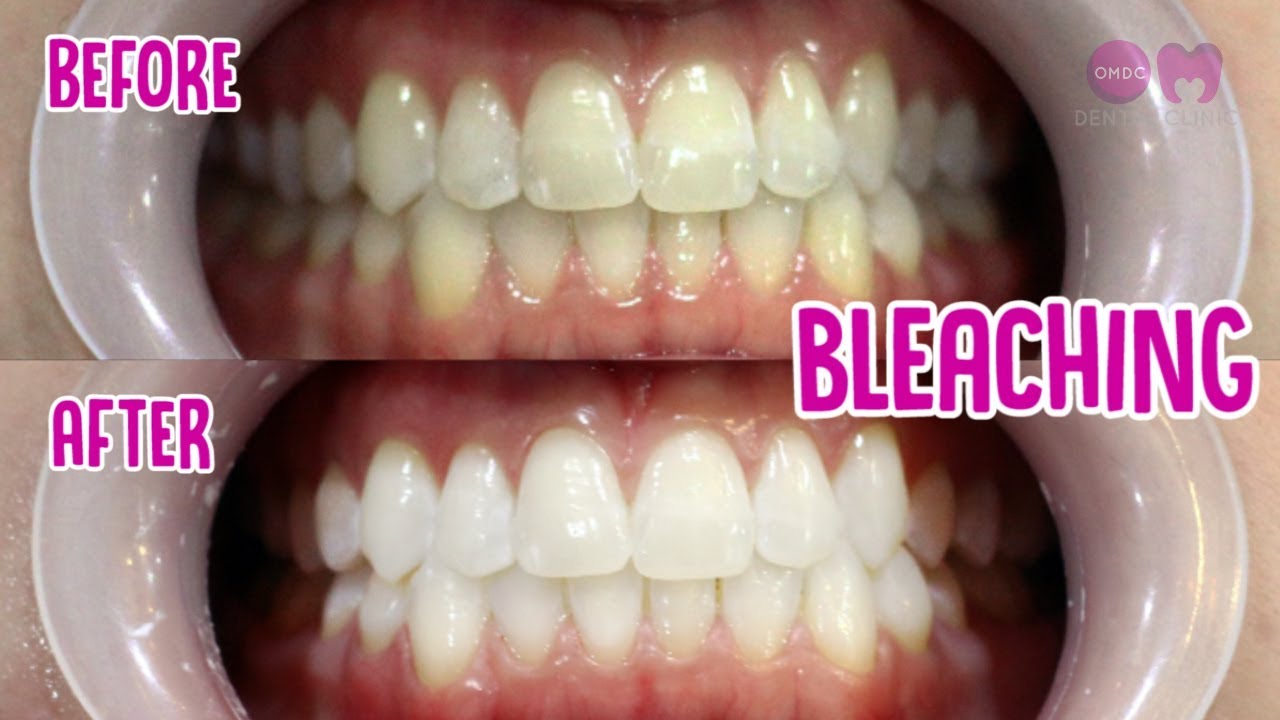 Before After Bleaching #2