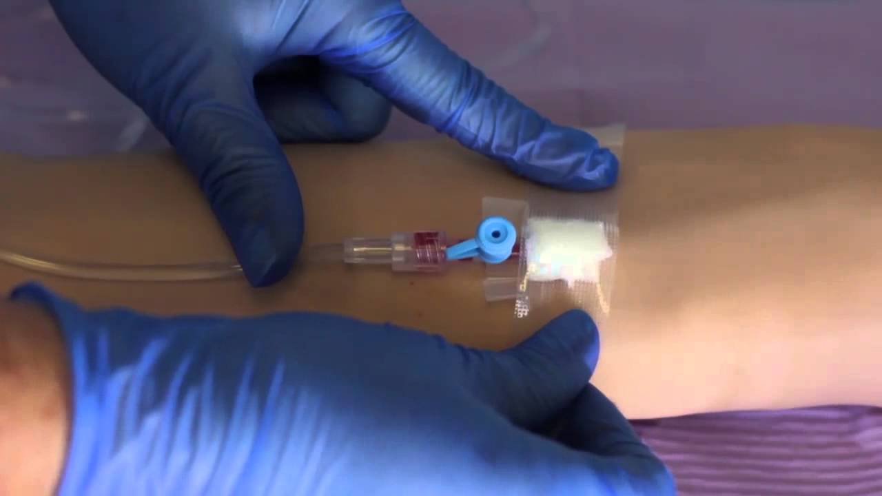 How to Start an Intravenous Line