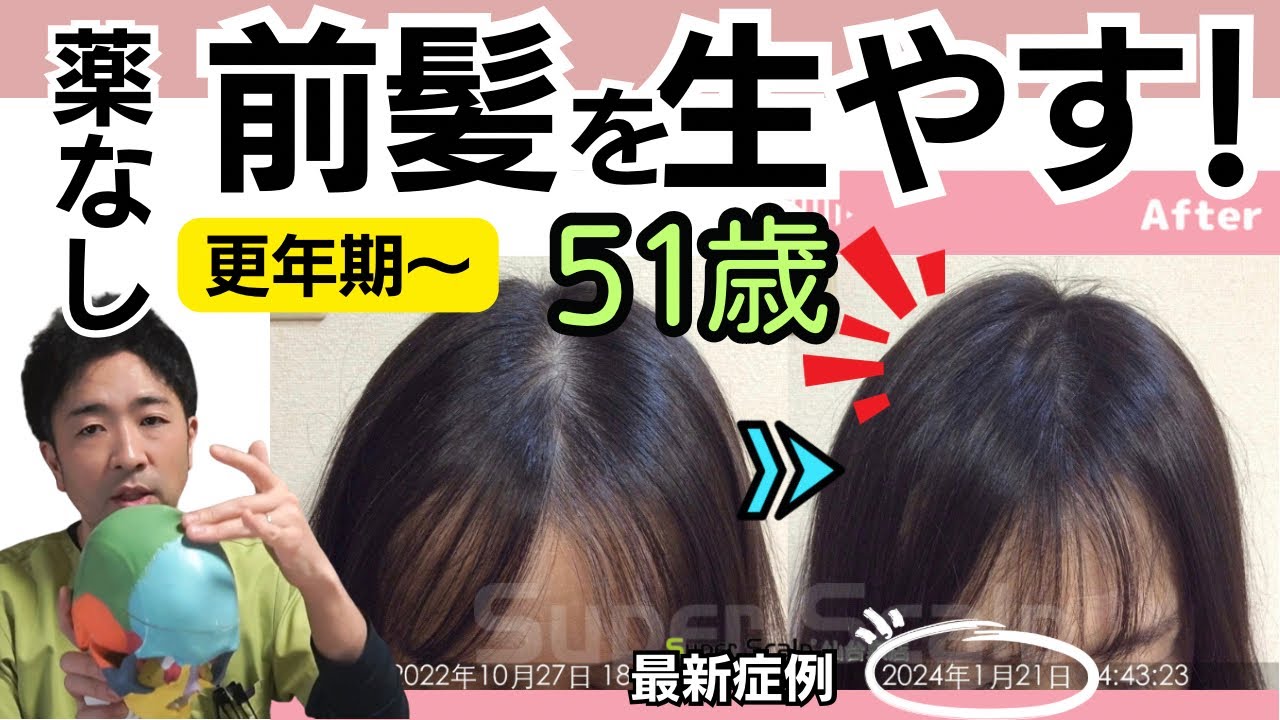 【51歳女性発毛症例】更年期の前髪薄毛を改善！お勧め自宅ケア3選