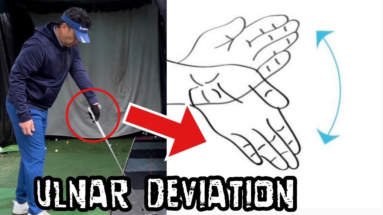 ULNAR DEVIATION MUST TRY