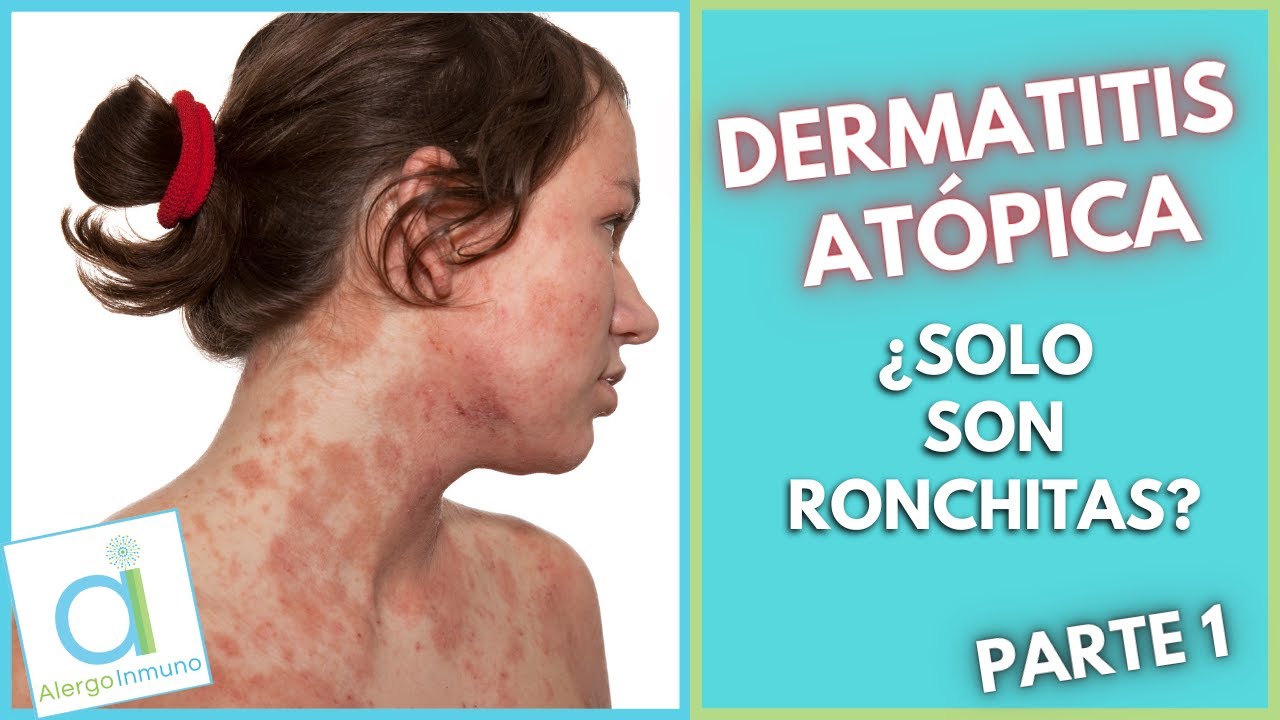 DERMATITIS ATÓPICA 😳  ¿Solo son ronchitas? 🤔