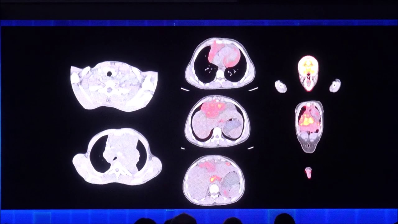Tumores del mediastino en pediatría. Rubén Montoya Cardenas