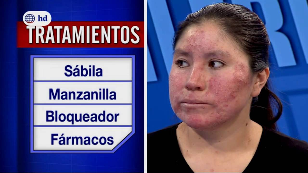DR.TV - Tubo de la Verdad: Rosácea
