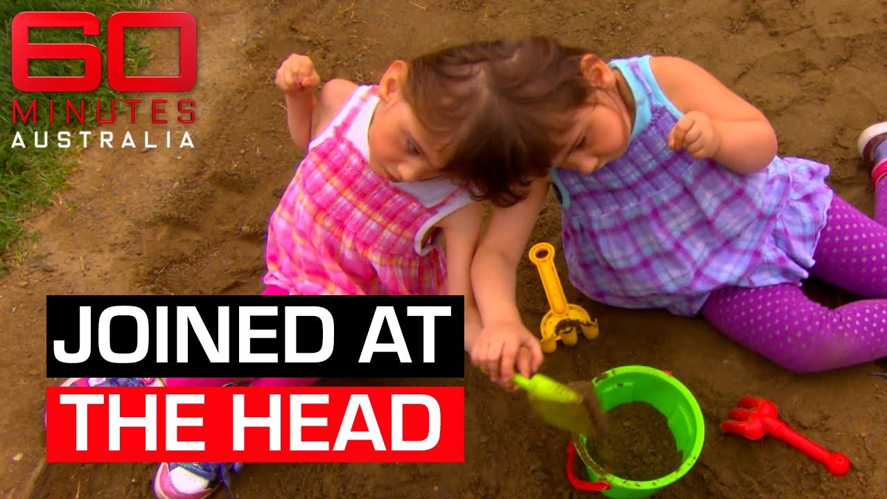The conjoined twins who see, smell and think the same things | 60 Minutes Australia