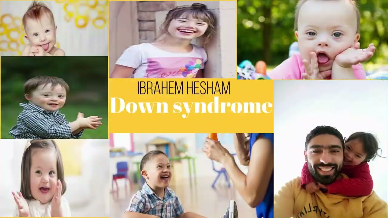 الاخصائي | الداون ( متلازمة داون) Downsyndrome