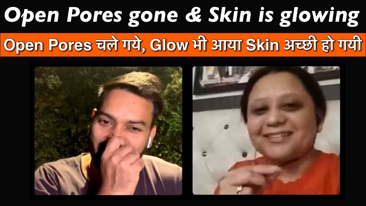Open Pores gone & skin is glowing. Open Pores चले गये, Glow भी आया Skin अच्छी हो गयी