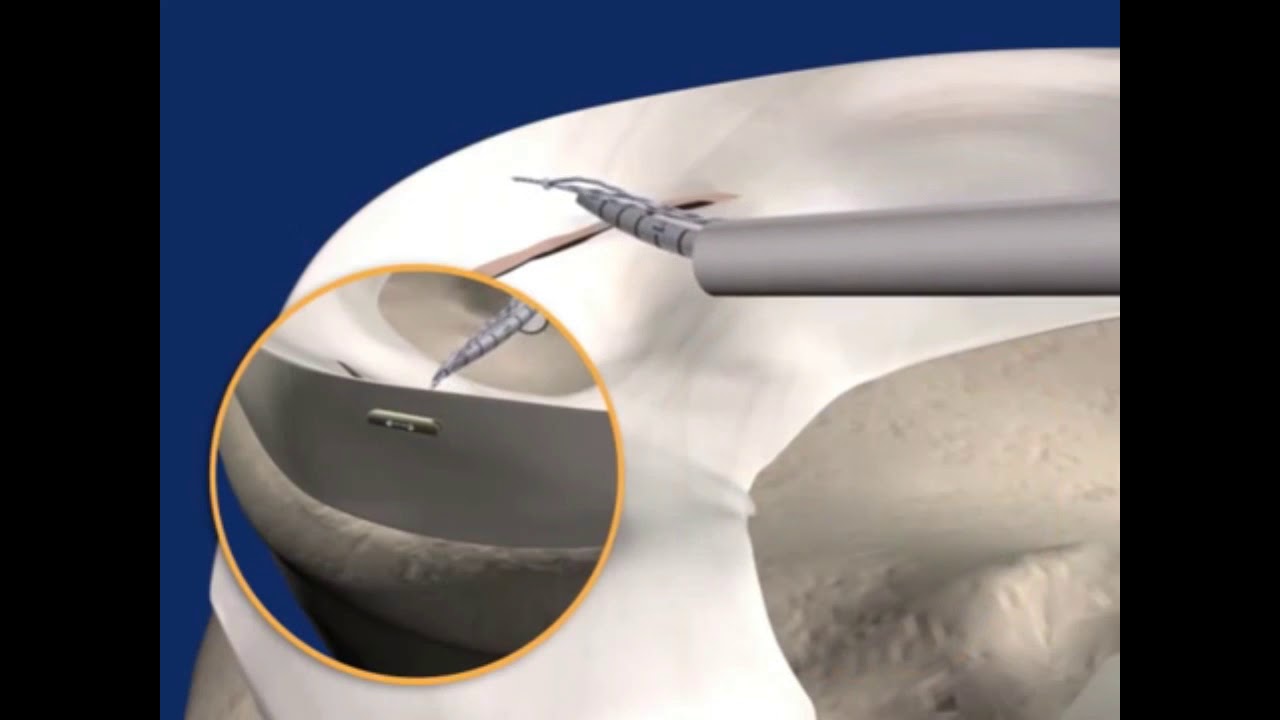 Fastfix full video animation