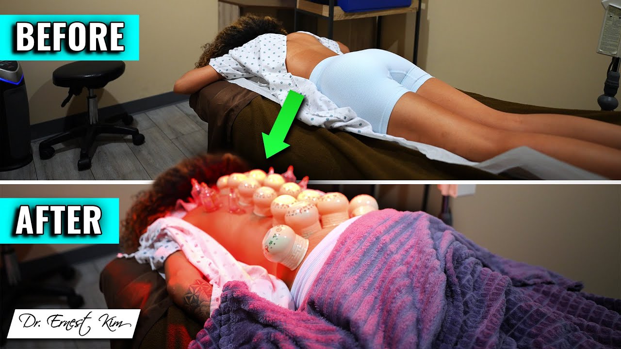 Relaxing Acupuncture And Fire Cupping | Her FIRST Time Ever