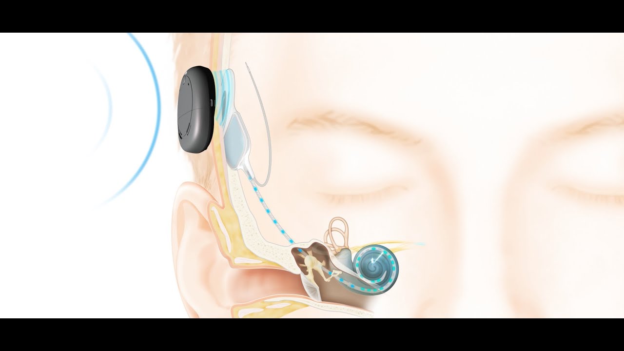 How the Cochlear&trade; Nucleus&reg; Kanso&trade; Implant System Works