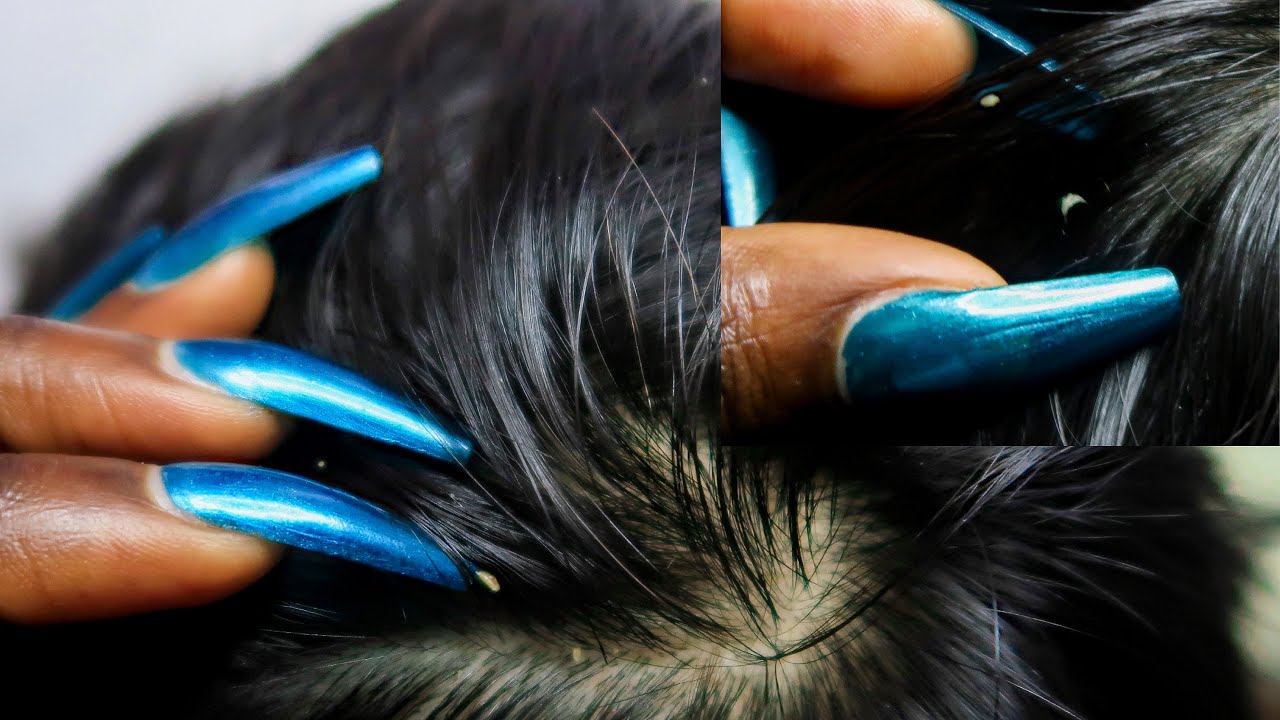 ASMR Allzoomed Full Head Scalp Nitpicking Whiteheads 1HR 🤯.