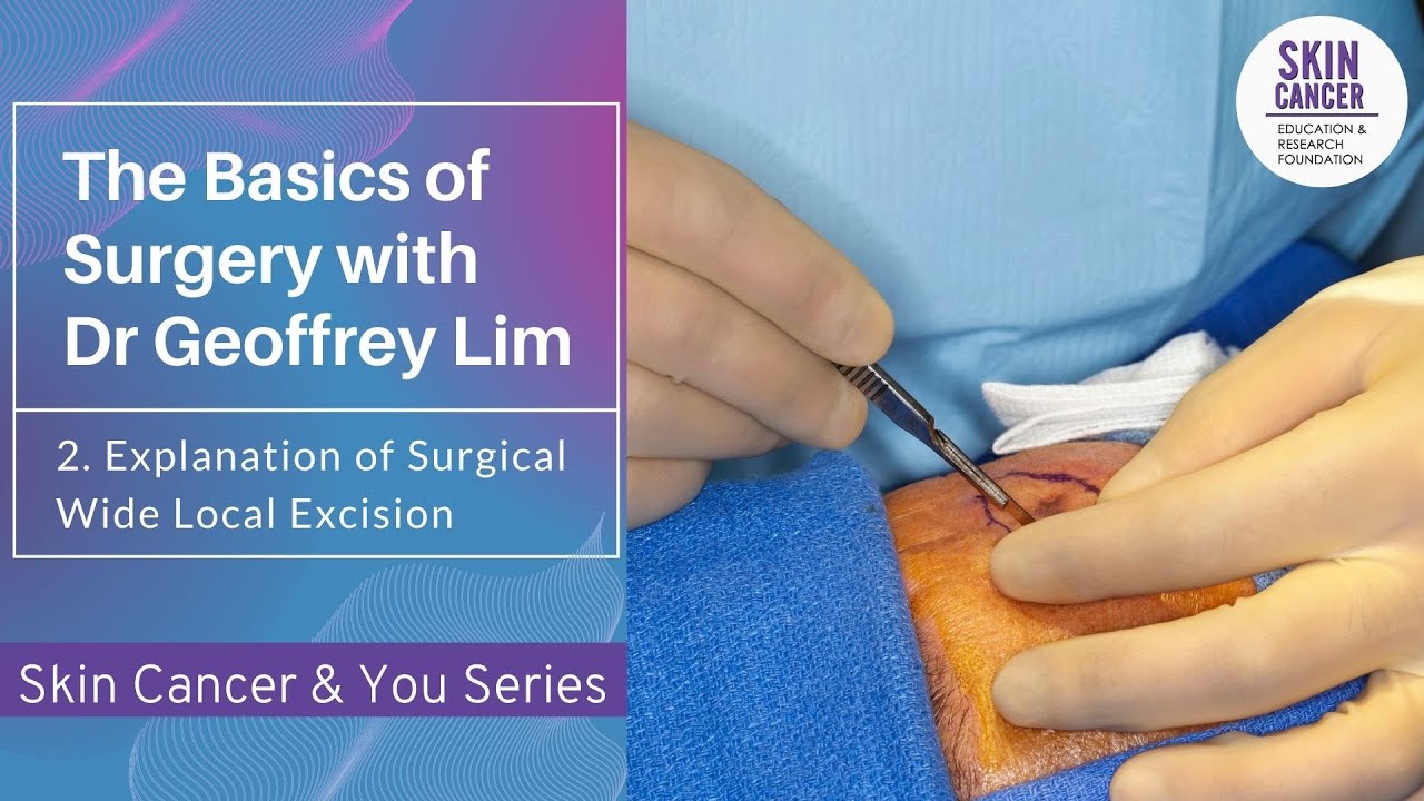 2. Explanation of Surgical Wide Local Excision: Basics of Surgery with Geoffrey Lim