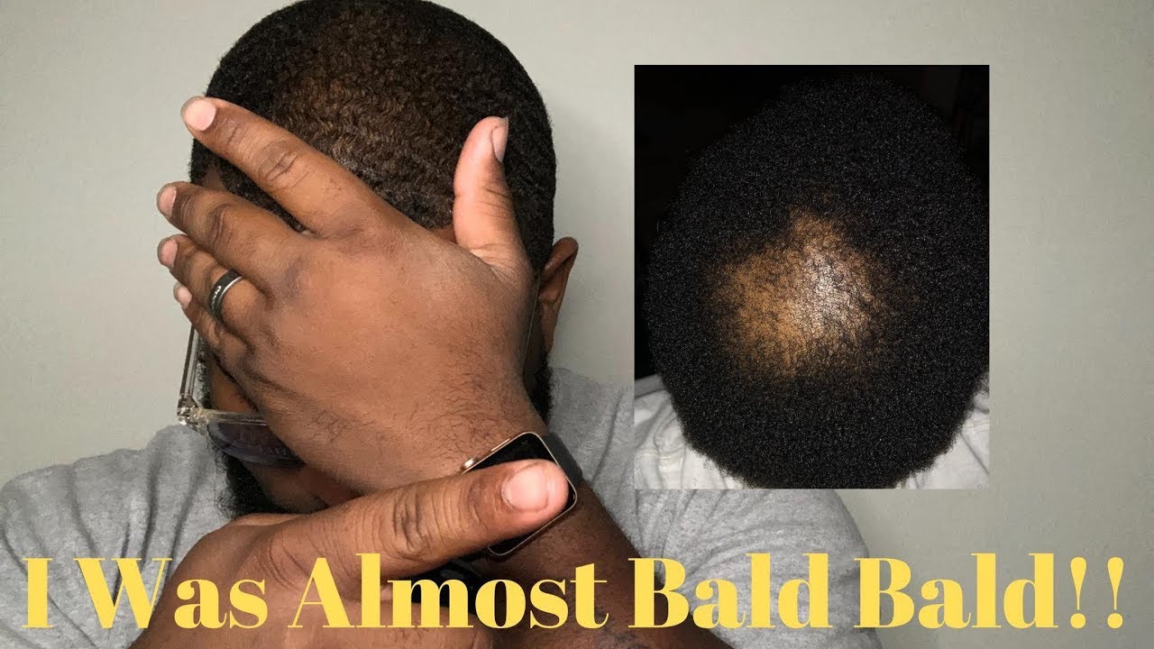 MY HAIR RE-GROWTH JOURNEY | BHP REVIEWS
