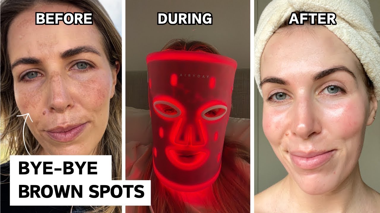 How I got rid of my melasma - cosmelan peel review