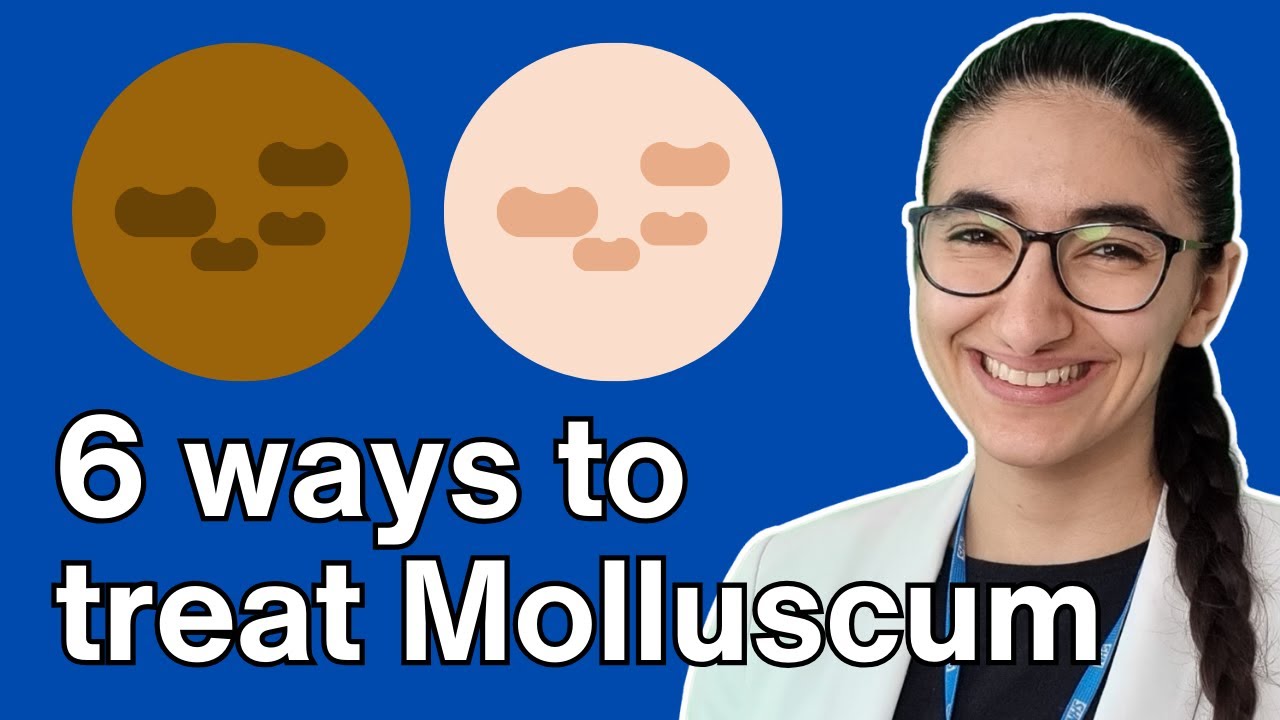 How to treat molluscum contagiosum with Pharmacist Virginia