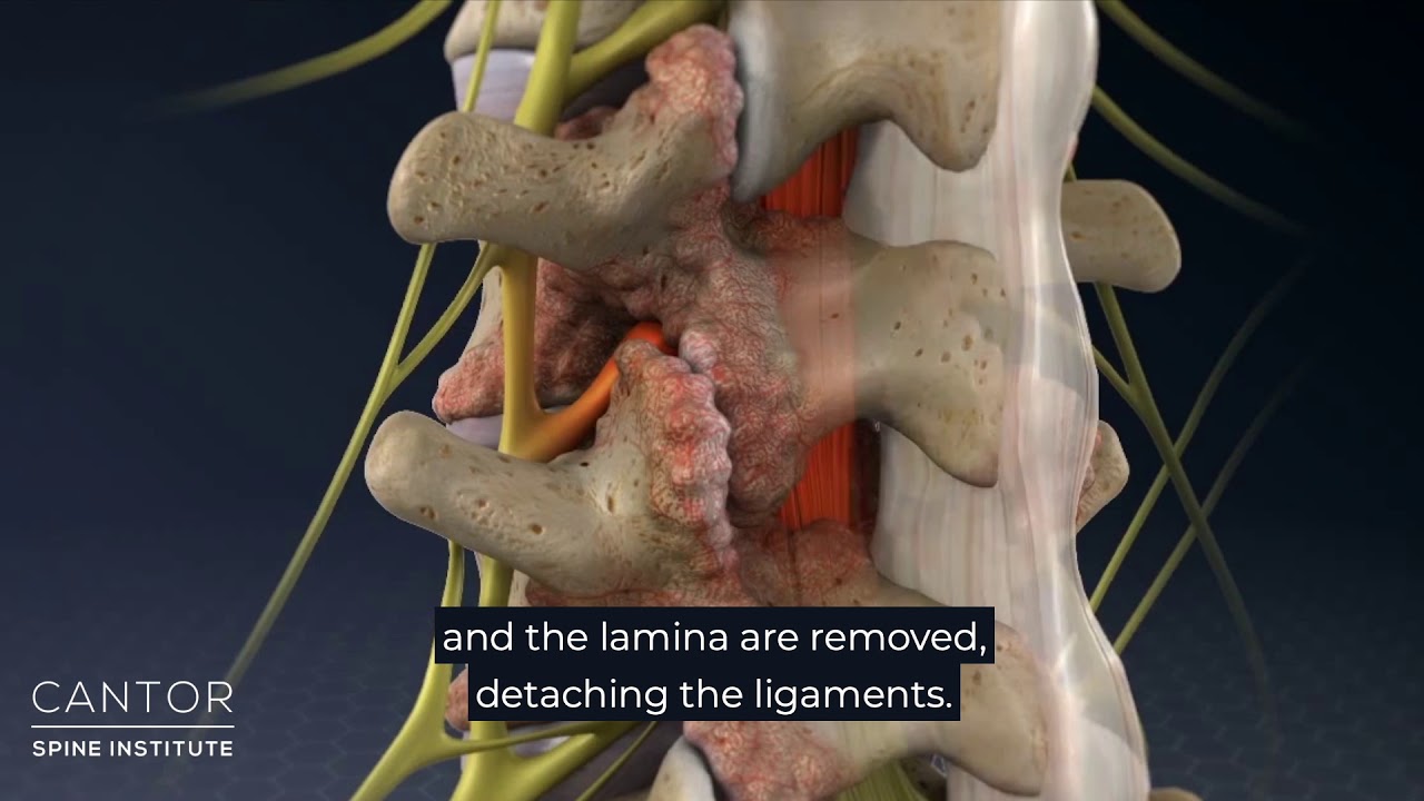 What is Ultrasonic Laminaplasty?