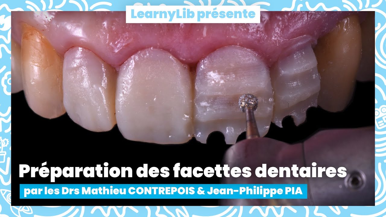 🦷 Les facettes dentaires : l'étape de la préparation avec les Drs CONTREPOIS et PIA