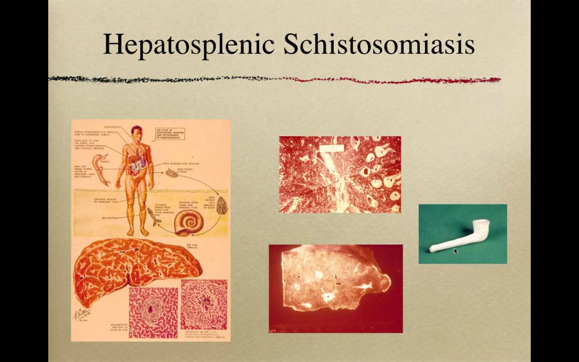 Ultrasound for Schistosomiasis