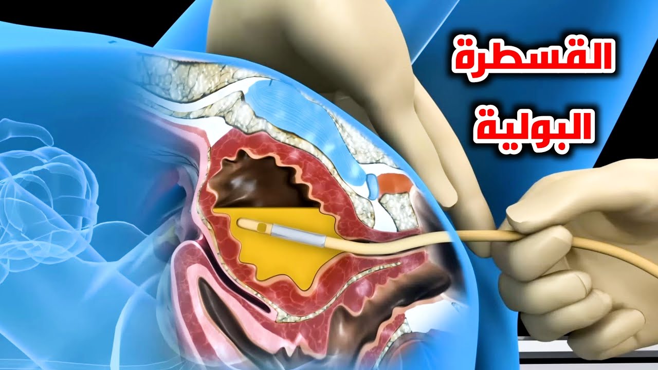 شاهد وتعلم كيفية تركيب القسطرة البولية للنساء _ Female Foley Insertion (Urinary Catheter)