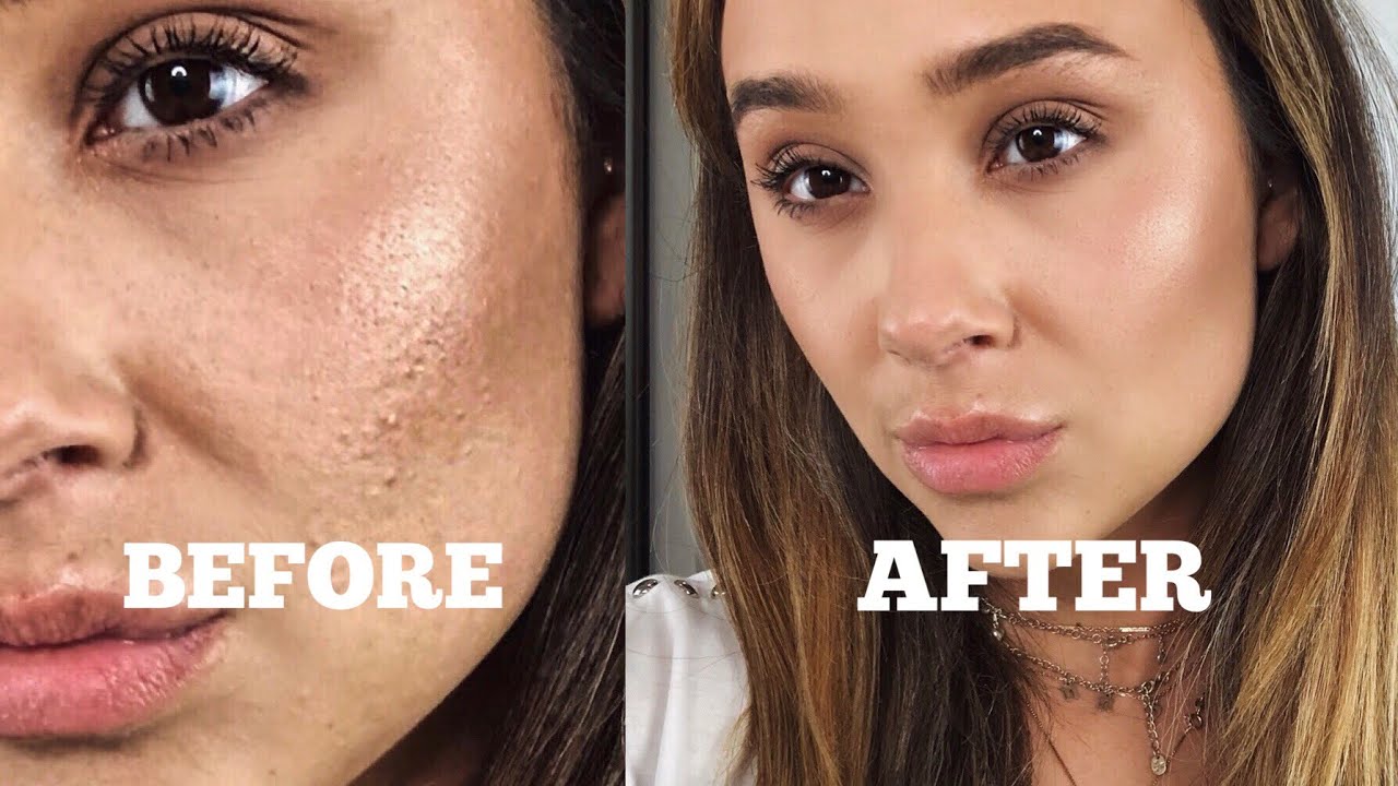 HOW TO COVER ACNE WITHOUT LOOKING CAKEY!