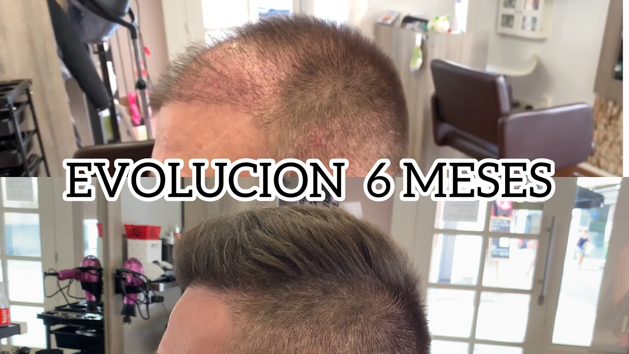 6 MESES trasplante capilar o injerto de cabello