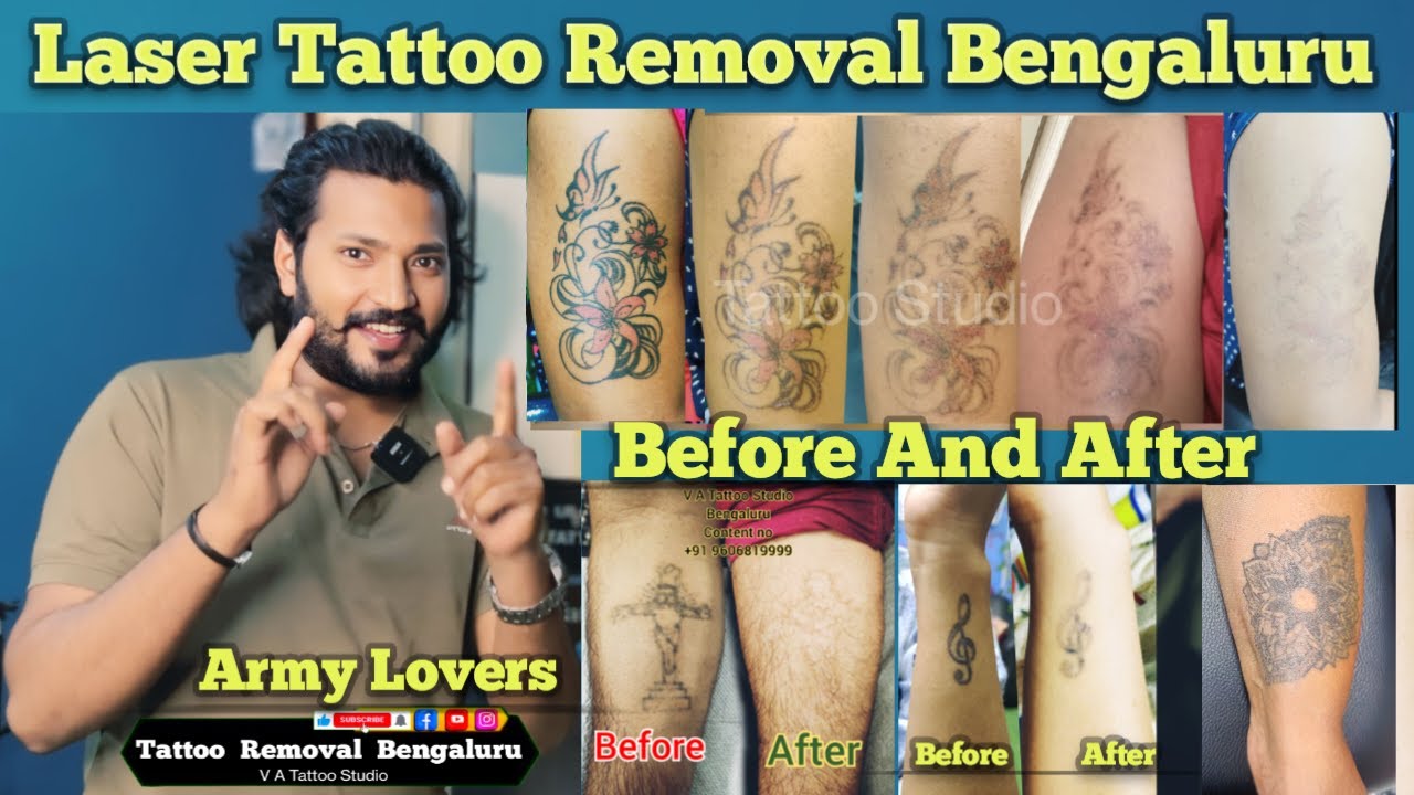 Laser Tattoo Removal 100% Result Befor and After | Best Tattoo Removal in Bengaluru 