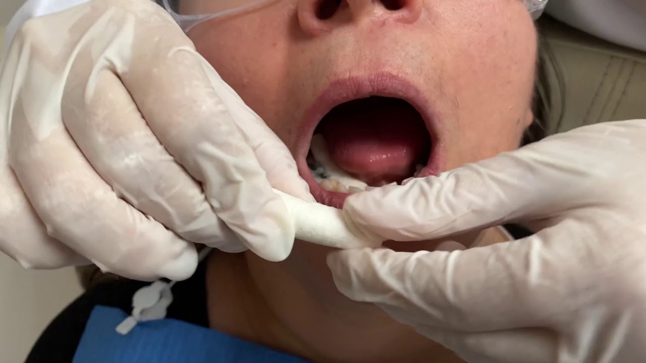 Aplicación de Flúor en Gel