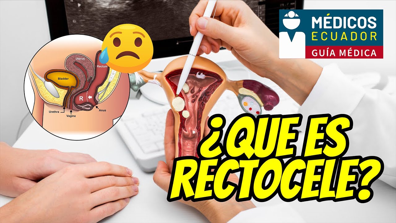 RECTOCELE diagnóstico, Síntomas y tratamiento, PROLAPSO de Órganos pélvicos - Tenesmo rectal #pelvis