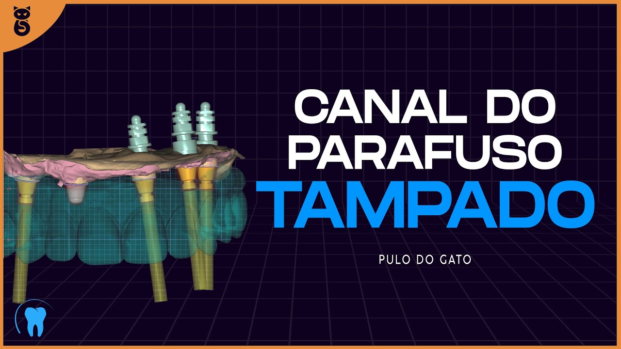 EXOCAD : Assentamento do implante com canal do parafuso tampado