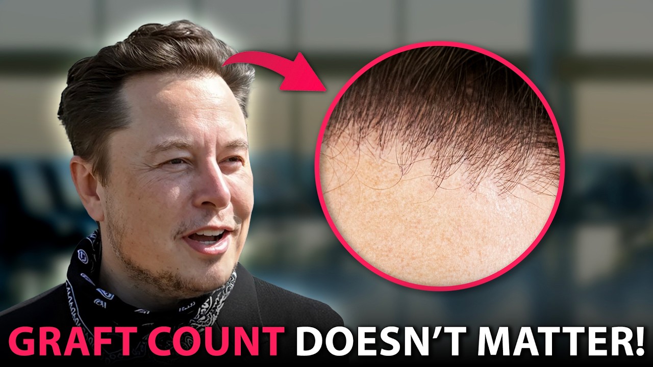 The #1 BEST Tip For A Hair Transplant