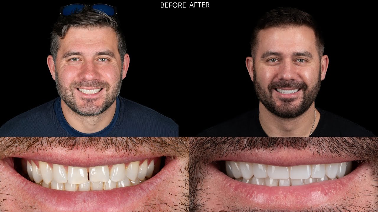Teeth Squeezed In? See How We Fixed Them! (Bonding and Occlusion)